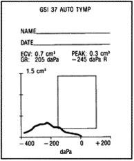 Tympanogram, serøs otitt med luftblærer