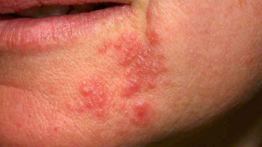 perioral dermatitt i 16:9 format (eneste)