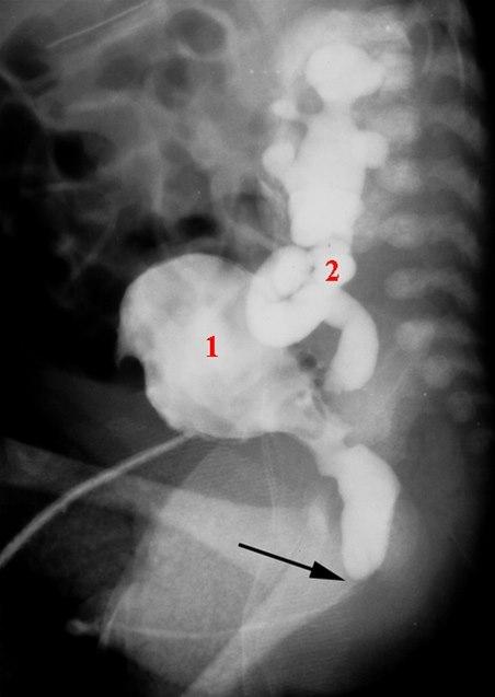 Urethraklaff (miksjonscystografi)