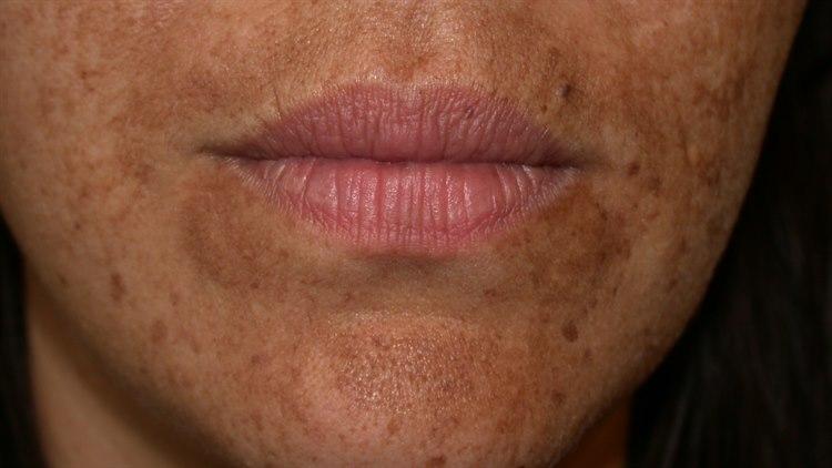 Hudlidelser svangerskap, melasma