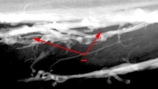 Venography DVT