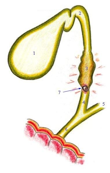 Galleblære - stein i midtre choledochus