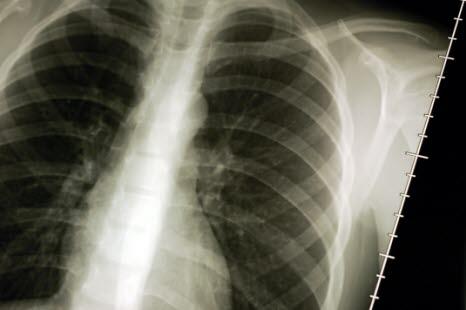 X-ray of the lungs