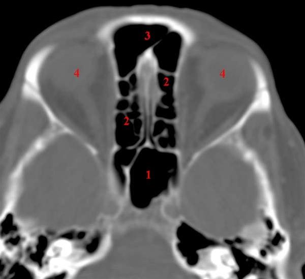 Ethmoidal- og sphenoidalsinus, axial