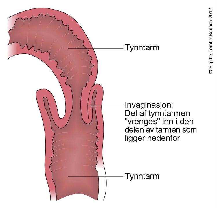 Invaginasjon av tarm