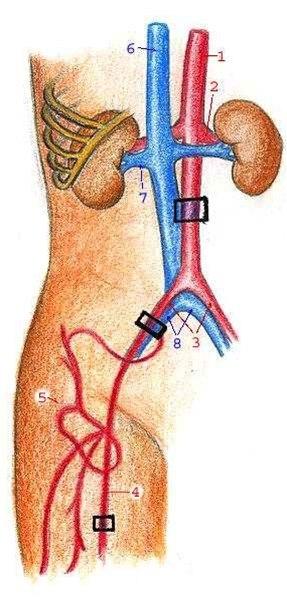 Aterosklerose i aorta iliaca femoralis