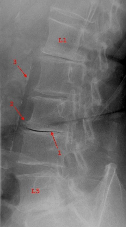 Spondylose og skivedegenerasjon