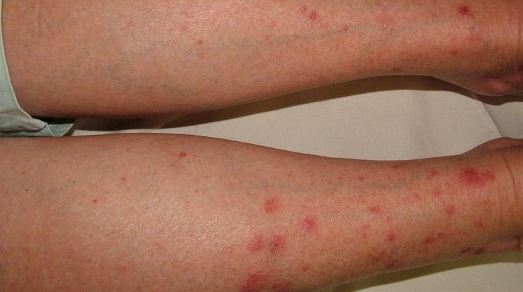 Soleksem (polymorf lysdermatose)