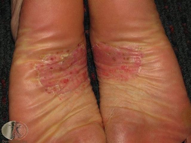 Pustulosis palmoplantaris