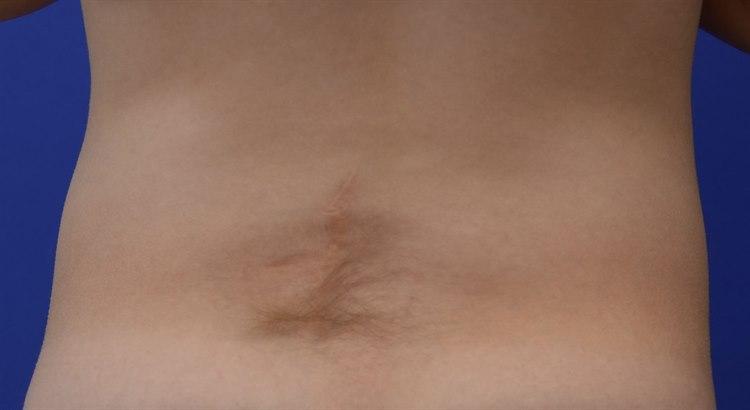 47333-2-spina-bifida-occulta-hartegn.jpg