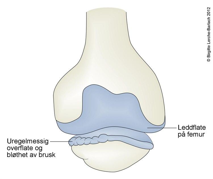 Nedre del av lårbeinet øverst, patella nederst. Blåe områder er brusk.