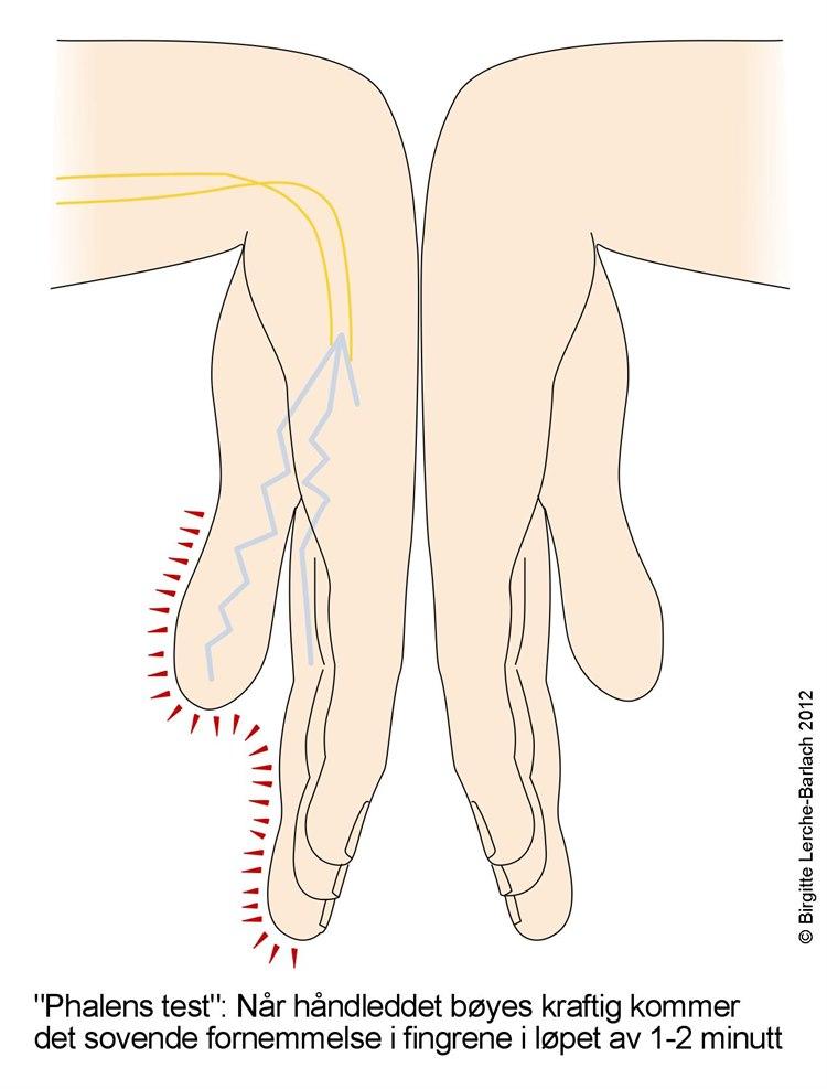 Tegning af Phalens test