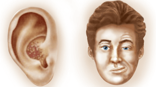 Illustrasjonstegningen viser et øre med herpes zoster utslett. Ved siden av vises et ansikt med halvsidig ansiktslammelse