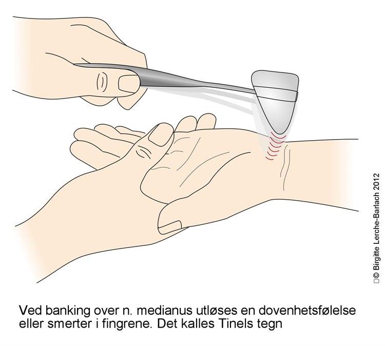 4564-2-karpaltunnelsyndrom-tinels-tegn.jpg