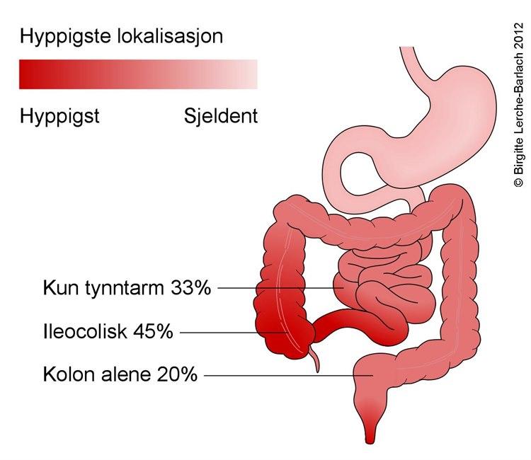 Crohns sykdom, lokalisasjon