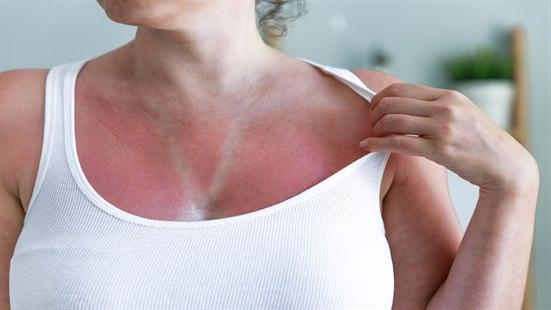 Bilde av kvinne som er solbrent på overkroppen.