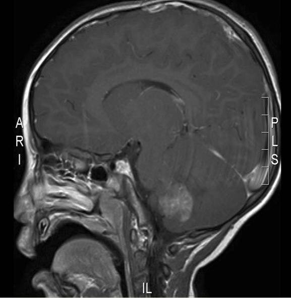 atypisk teratoid rhabdoid tumor 2