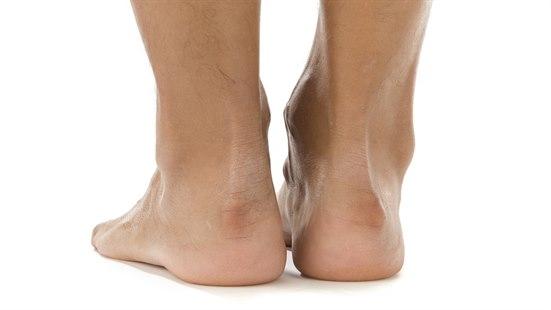 Illustrasjonsfotoet viser Haglunds hæl sett bakfra og tilstede på begge hæler