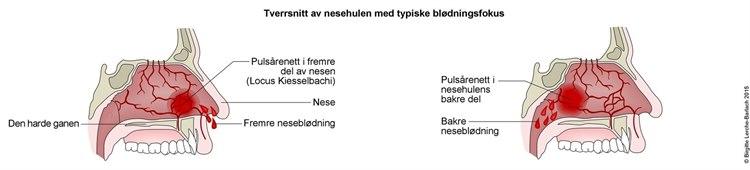 Plansjer som viser fokus for neseblødninger, fremre og bakre