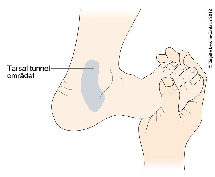 Tarsal tunnel test