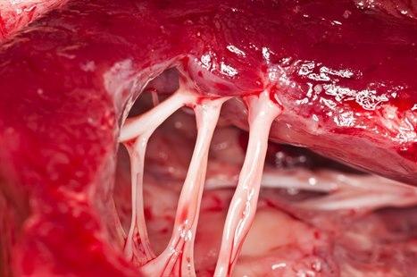 Hjerteklaff med tråder (chordae tendinae)
