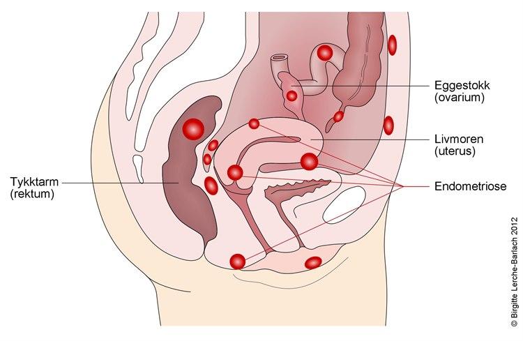 10054-2-endEndometriose, lokalisasjonerometriose-lokalisasjoner