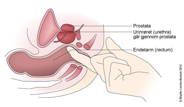 Undersøkelse av endetarm og prostata