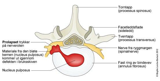 Lumbal disskusprolaps - tverrrsnitt