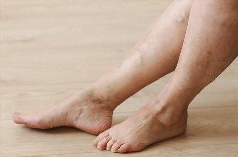 varicose and spider veins