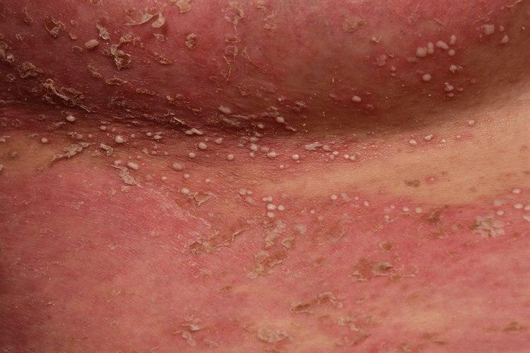 Pustulær psoriasis i svangerskapet. Irritert/rød hud med multiple pustler under bryst
