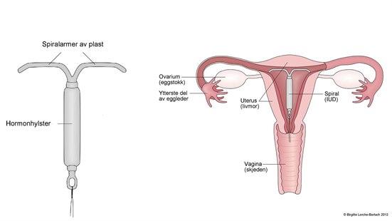 Illustrasjonsbilde av en hormonspiral og livmor med spiral