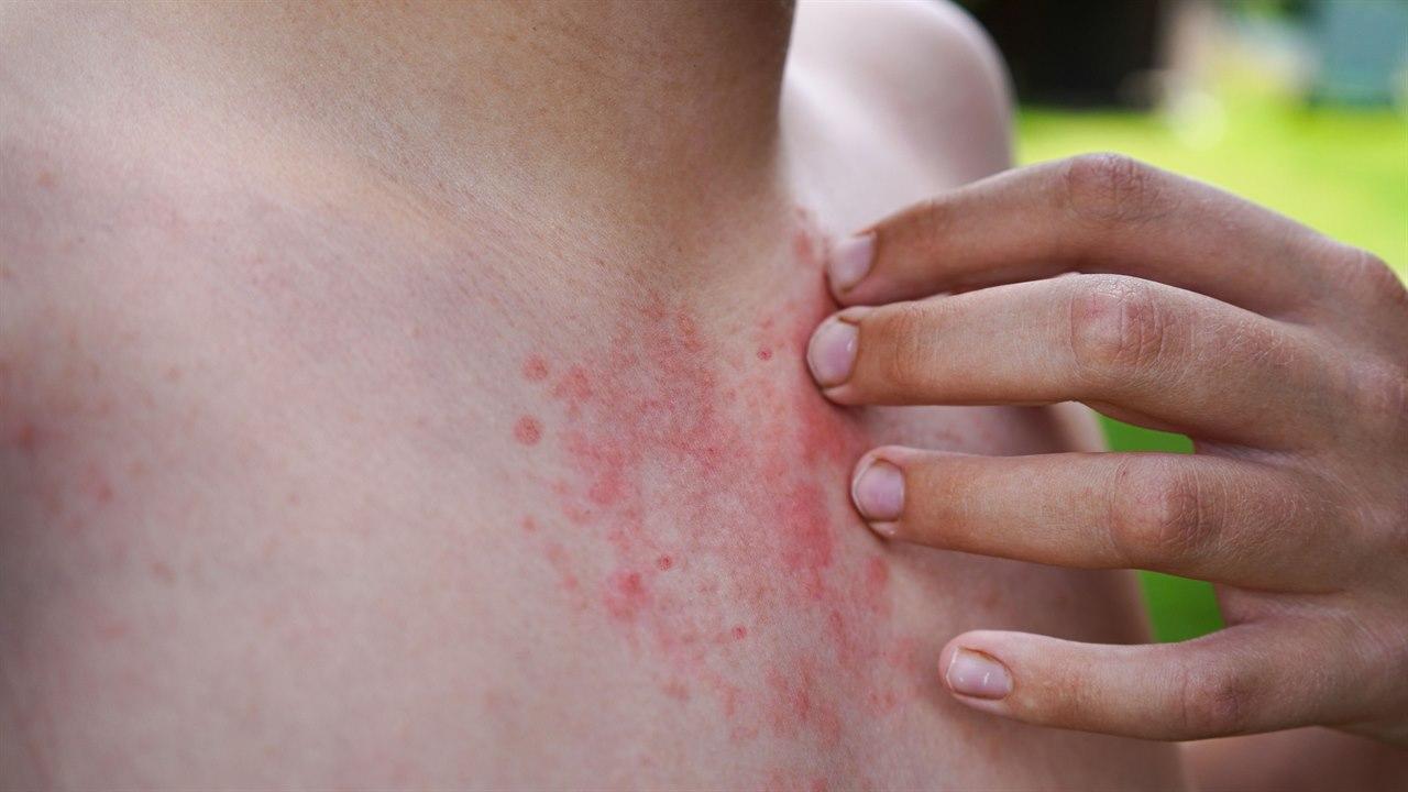 Illustrasjonsfotoet viser utslett etter skabb