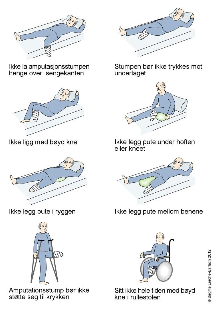 Gale amputasjonsstillinger