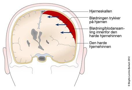 Hematom Embolisering av arteria meningea media ved kronisk subduralt hematom ...