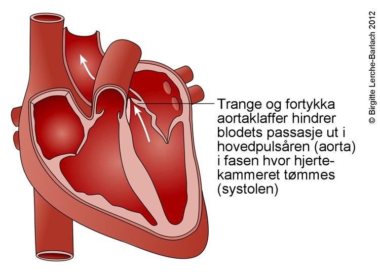Aortastenose Forsnevring I Aortaklaffen NHI no Aortastenose Forsnevring I Aortaklaffen NHI no